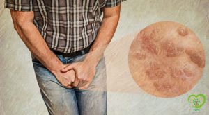 زگیل تناسلی(hpv) و قارچ گانودرما