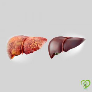 تاثیر گانودرما بر درمان کبد چرب